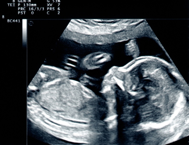 Emberi embrió