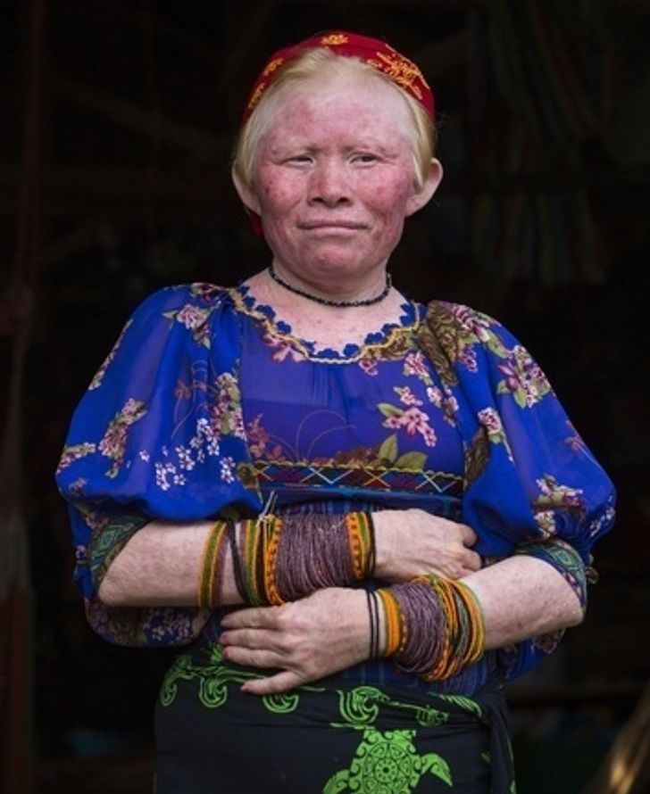 Kuna albínó emberek